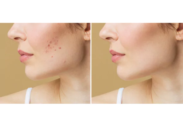 blemish-scar-mark-removal