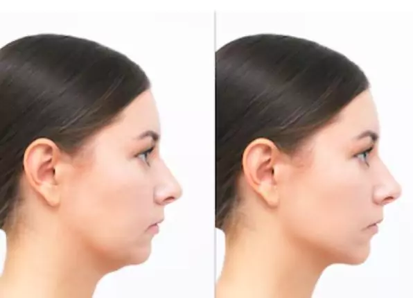 face-reshaping-and-contour-adjustment