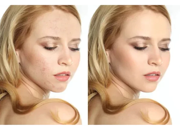 skin-smoothing-and-blemish-removal