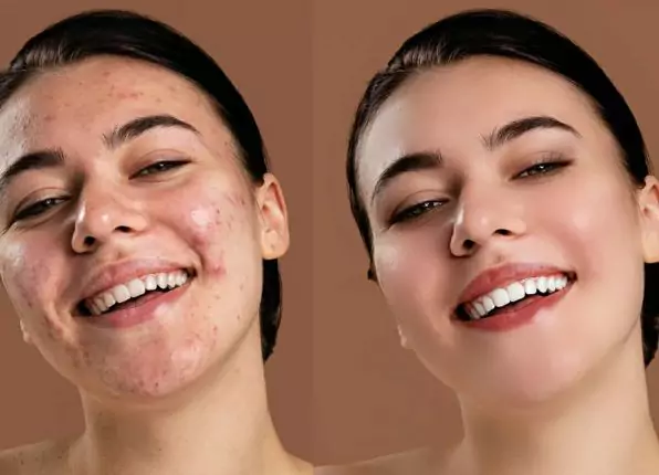 skin-smoothing-and-blemish-removal