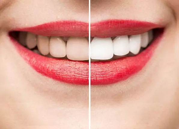 teeth-whitening-and-smile-enhancement