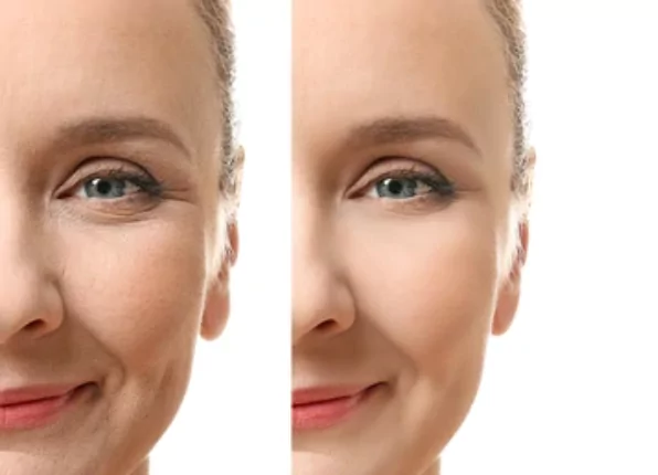 wrinkle-and-fine-line-reduction