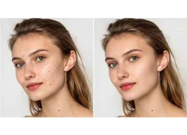 skin-smooth-and-blemishes-removal