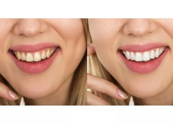 teeth-whitening